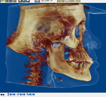 Imagen de cirugía ortognática 3d Dr. Antonio Marino